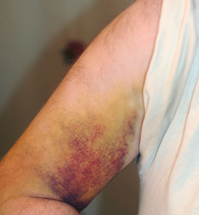 Bruise Bruise